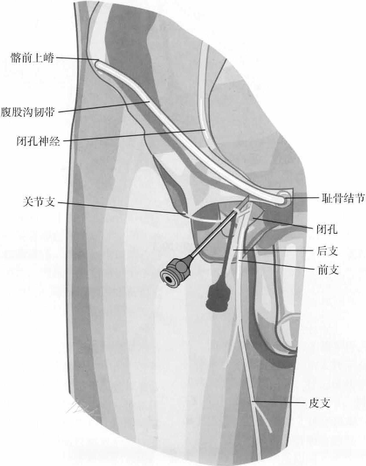 第四節(jié) 閉孔神經射頻鎮(zhèn)痛治療